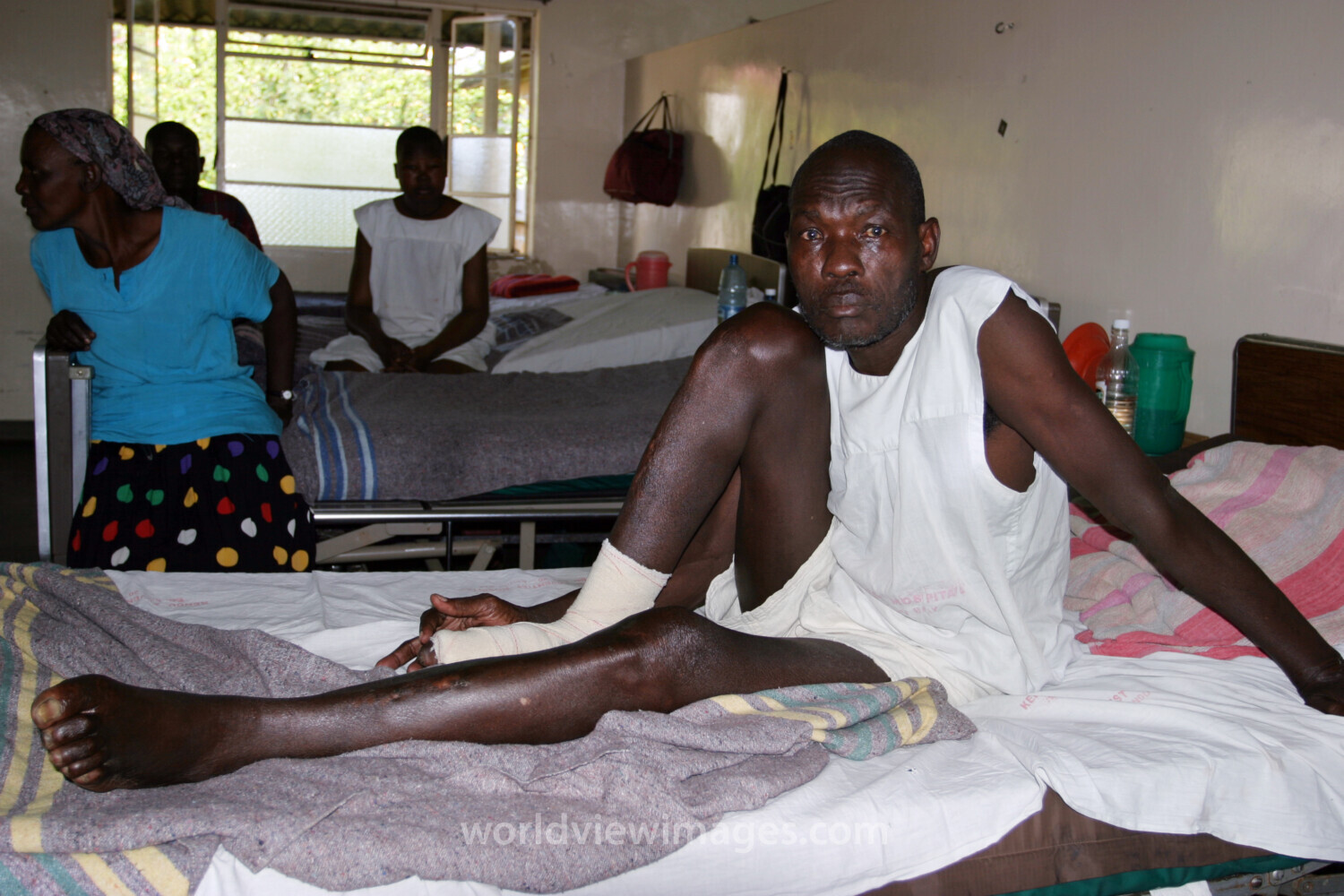 HIV/AIDS Patient in Hospital in Africa