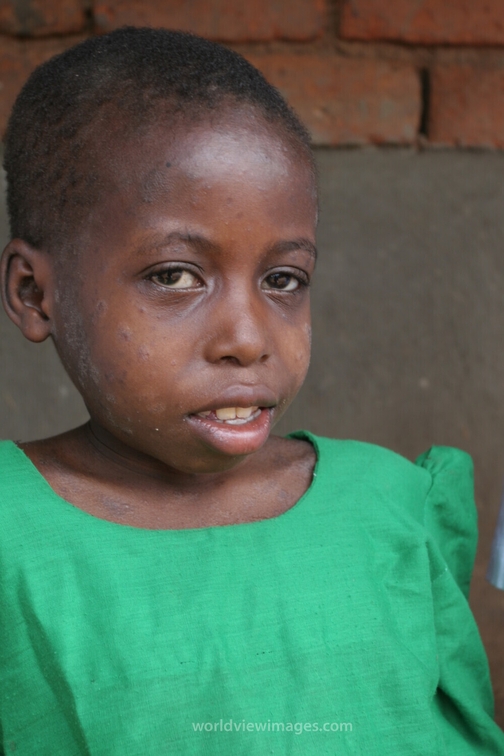 HIV Positive in Malawi