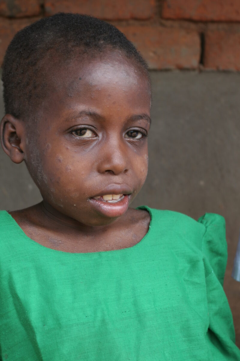 HIV Positive in Malawi — Yong girls with HIV infection, in Malawi — Malawi, Africa, girl, child, HIV