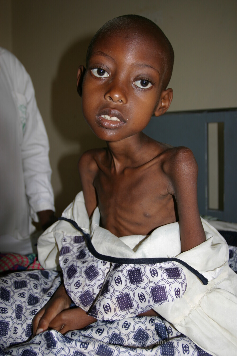 Girl with AIDS in Hospital