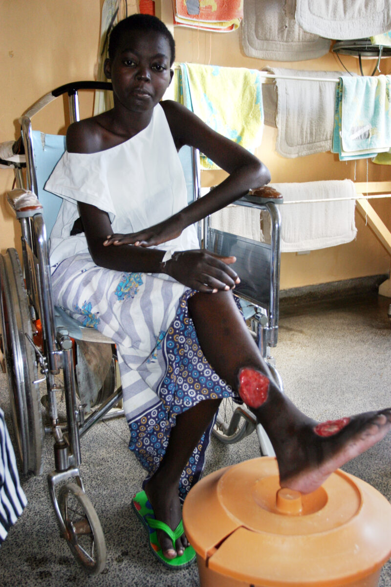 Girl in Hospital in Rwanda — Girl with tropical absess on her leg — Kenya, Africa, ADRA, tropical absess