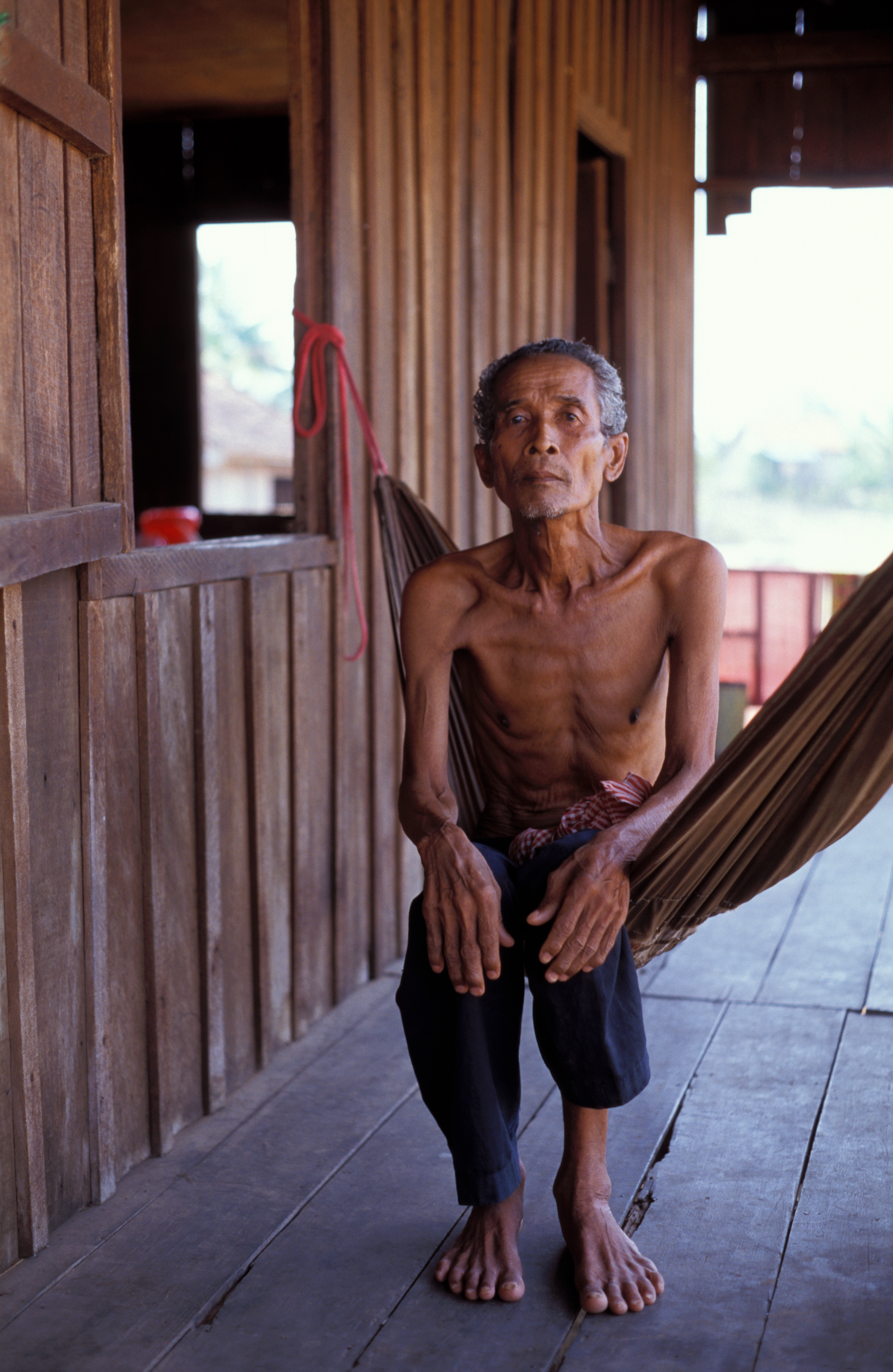 Man with TB in Cambodia