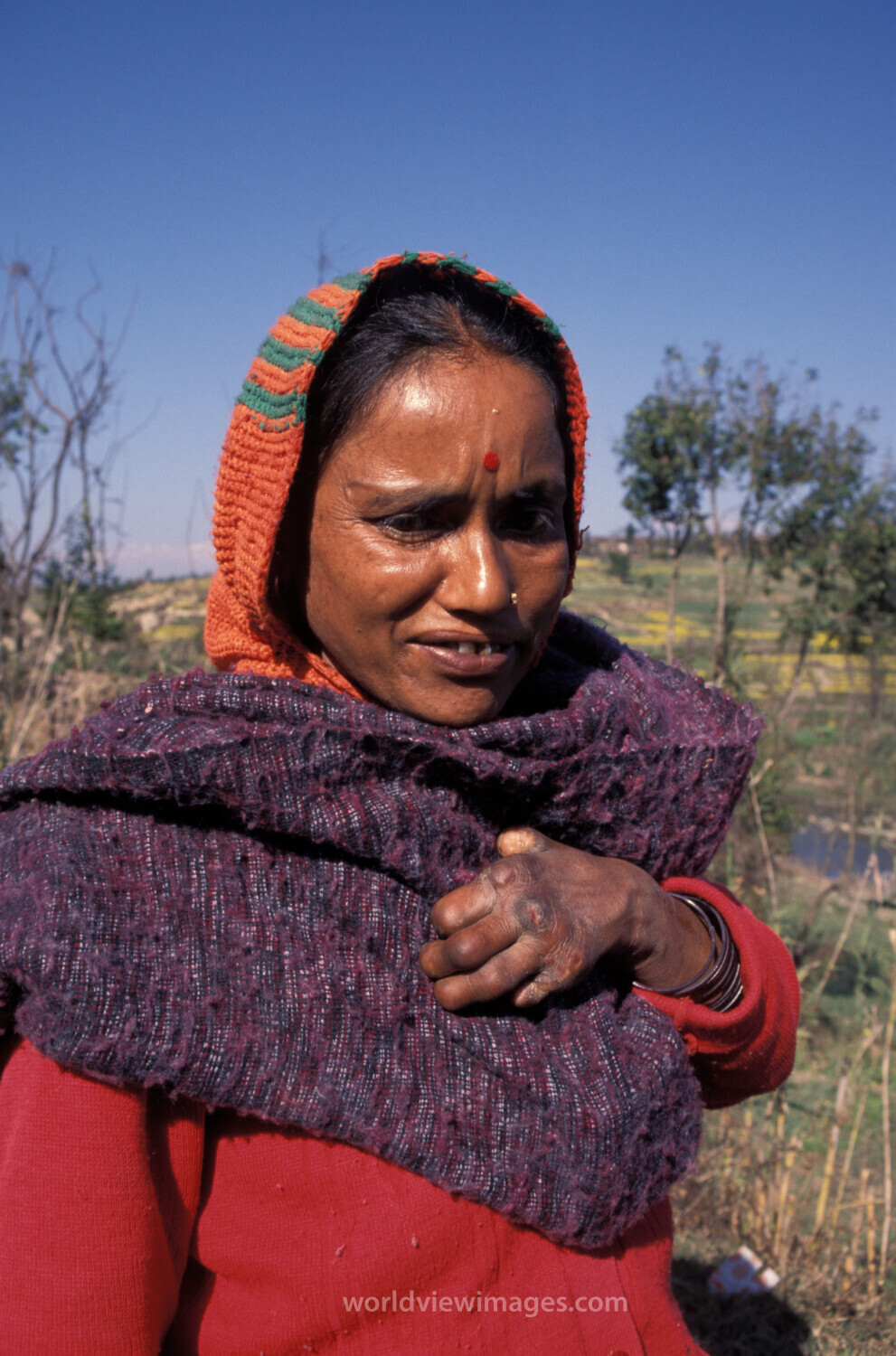 Woman with Leprosy in Nepal