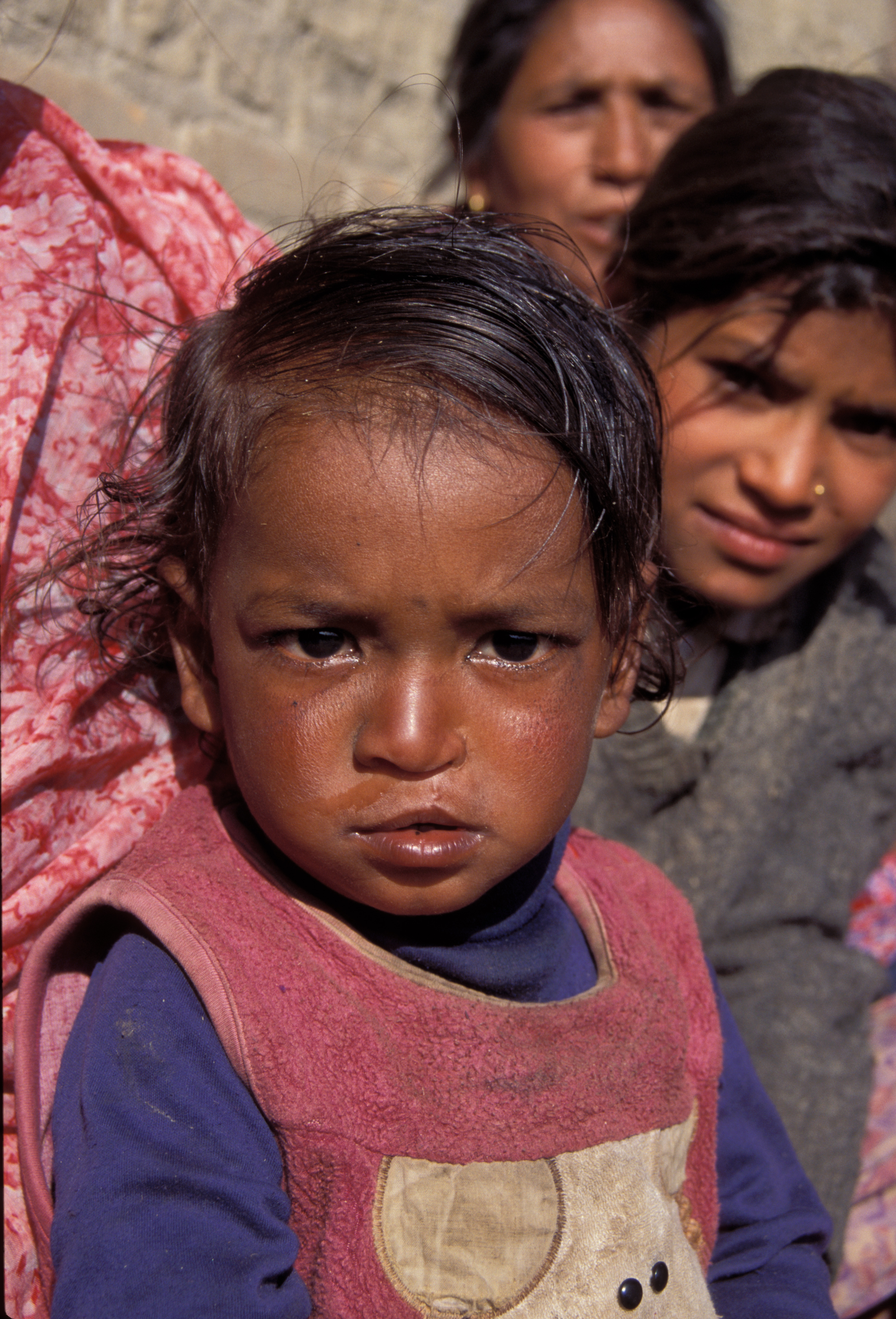 Boy After Operation in Nepal