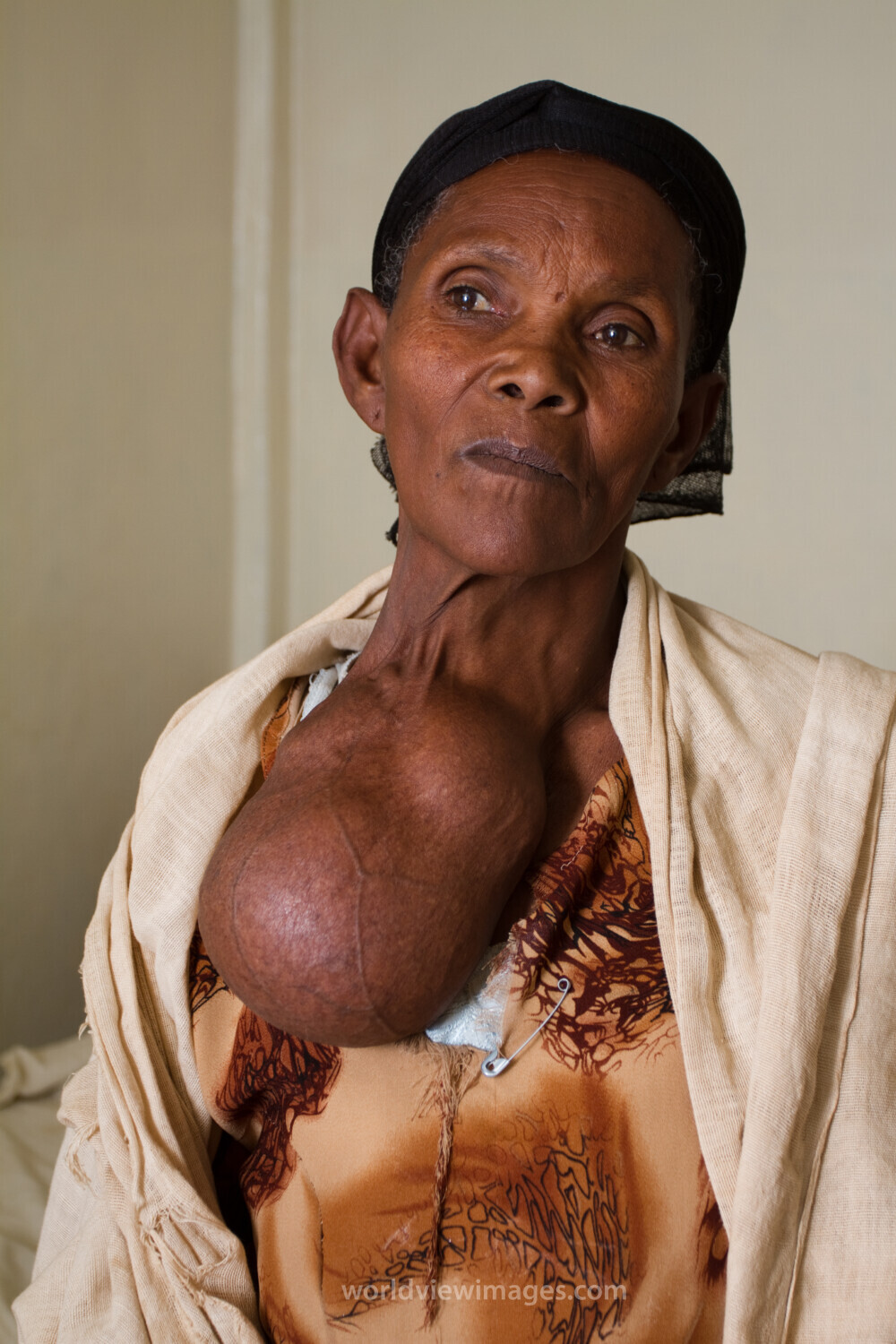 Woman with Goiter