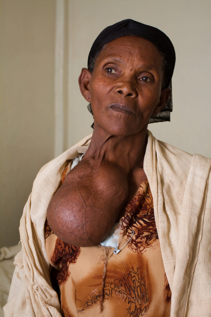 Woman with Goiter — Stock shots of Gimbii Adventist Hospital in Ethiopia, Africa: woman with large Goiter, from a lack of iodine in her diet. — Ethiopia, Afr...