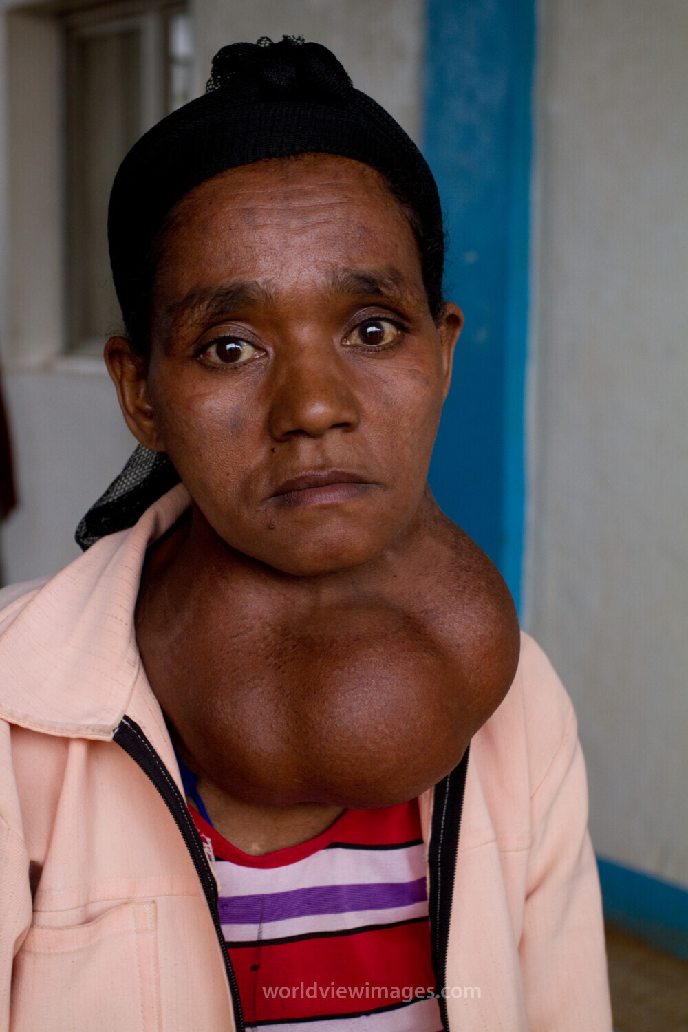 Woman with Goiter