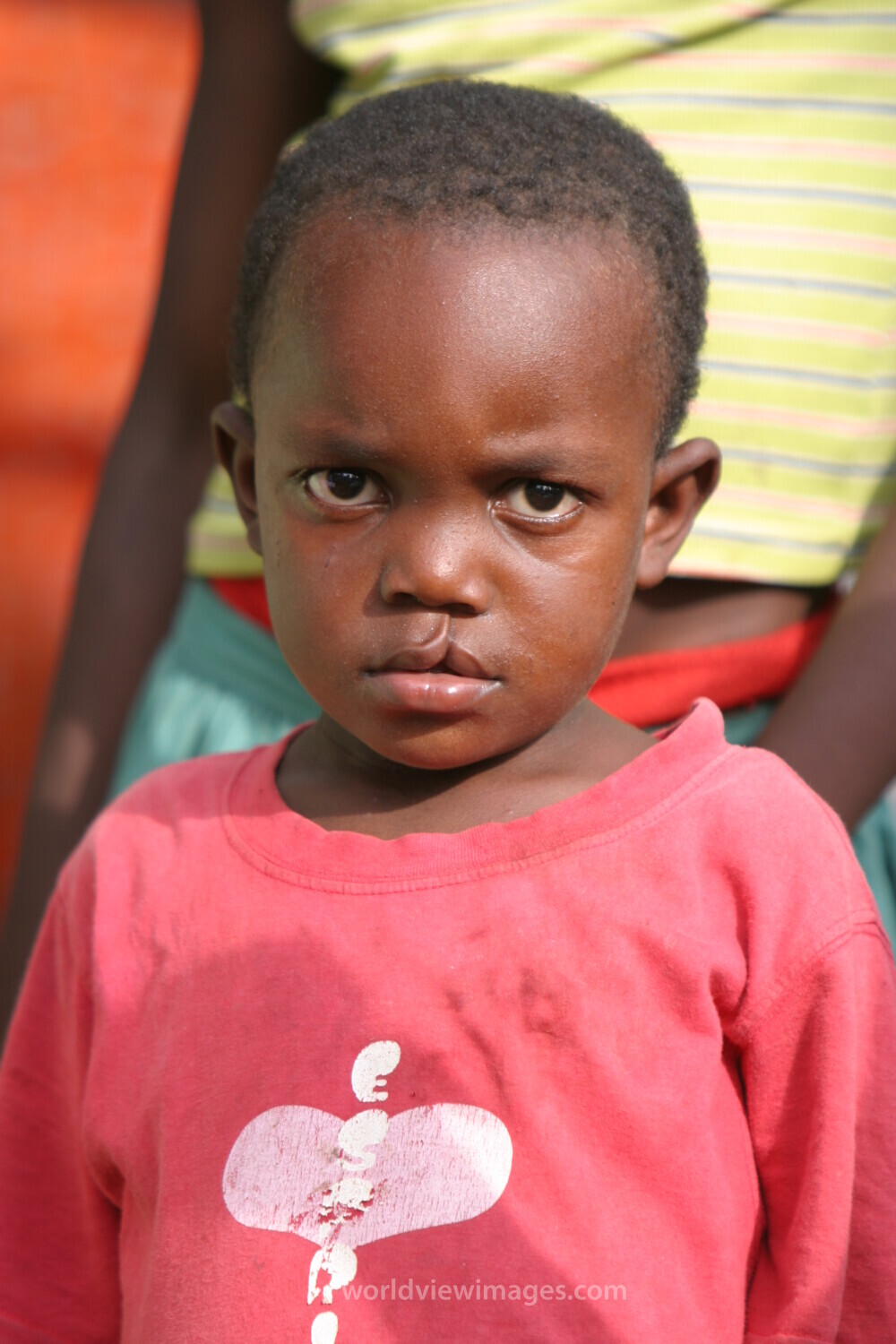 Boy with Cleft Lip in Sau Tome, Africa