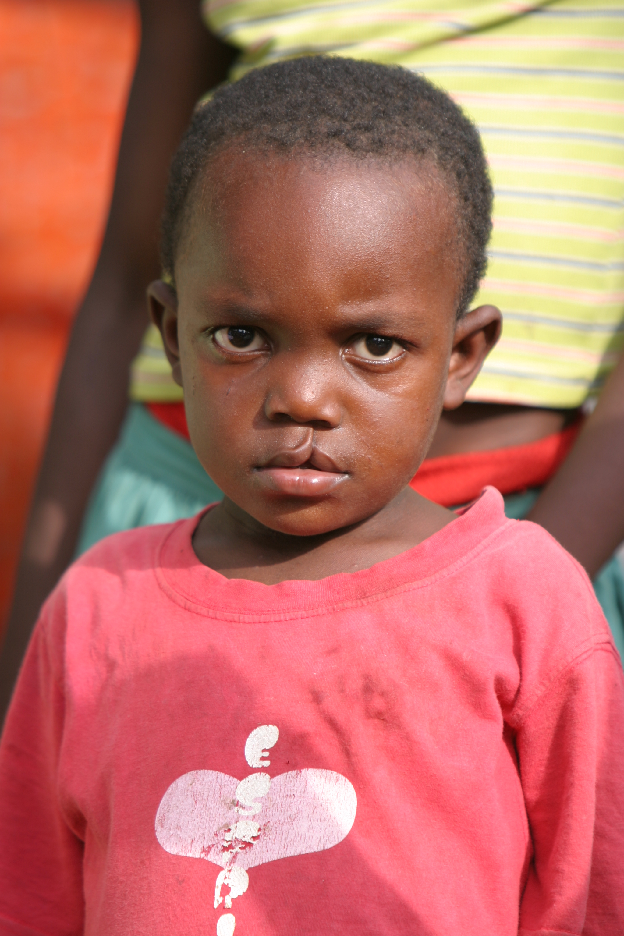 Boy with Cleft Lip in Sau Tome, Africa