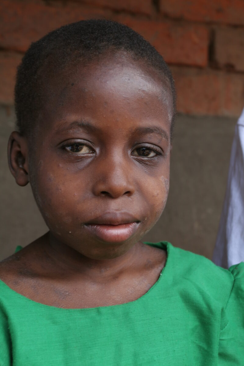 HIV Positive Girl in Malawi — Young girl in Malawi struggles with the opportunistic illnesses that come with being HIV positive. — Malawi, Africa, ADRA, girl...