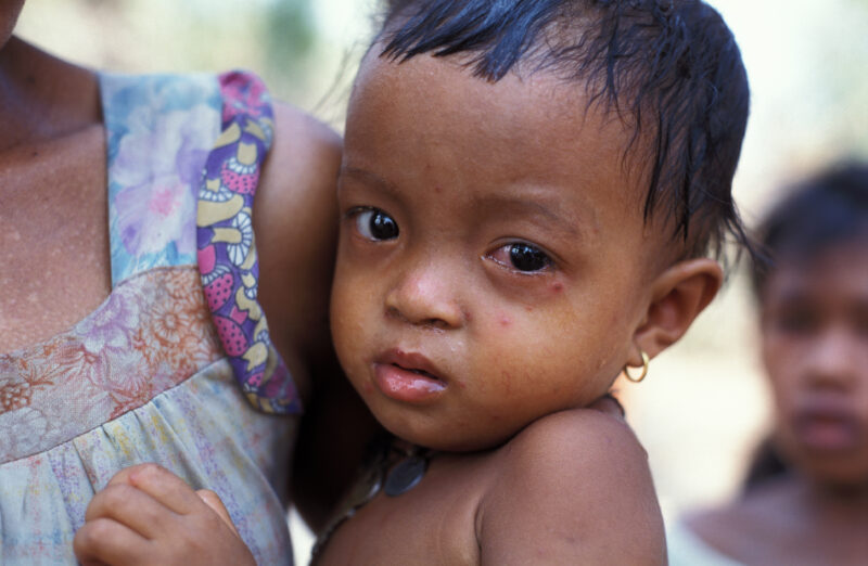 Sick Baby in Cambodia — Baby with eye infection in Cambodia — Baby, Cambodia, health, eye, infection