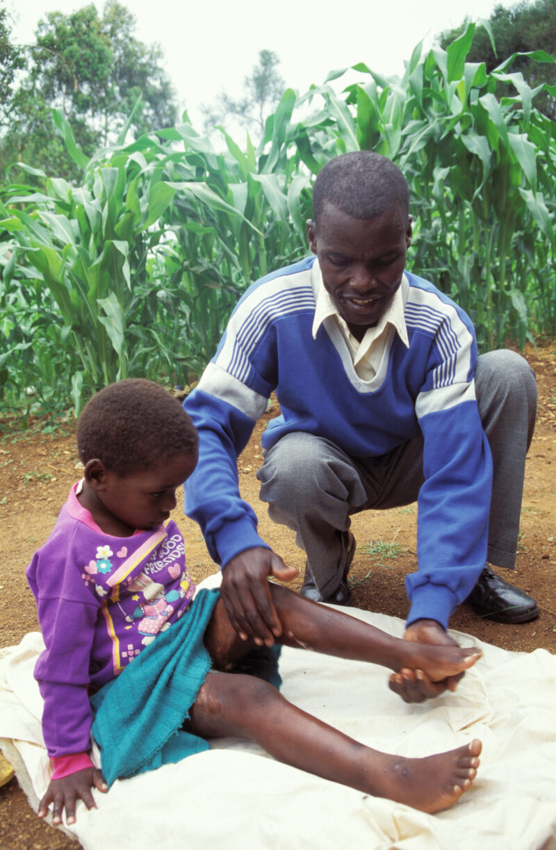 Disabled Child in Kenya — Stock image of child with disability finding hope and hepl at the Nyburi center for disabled children in Kenya. — Children, disabil...