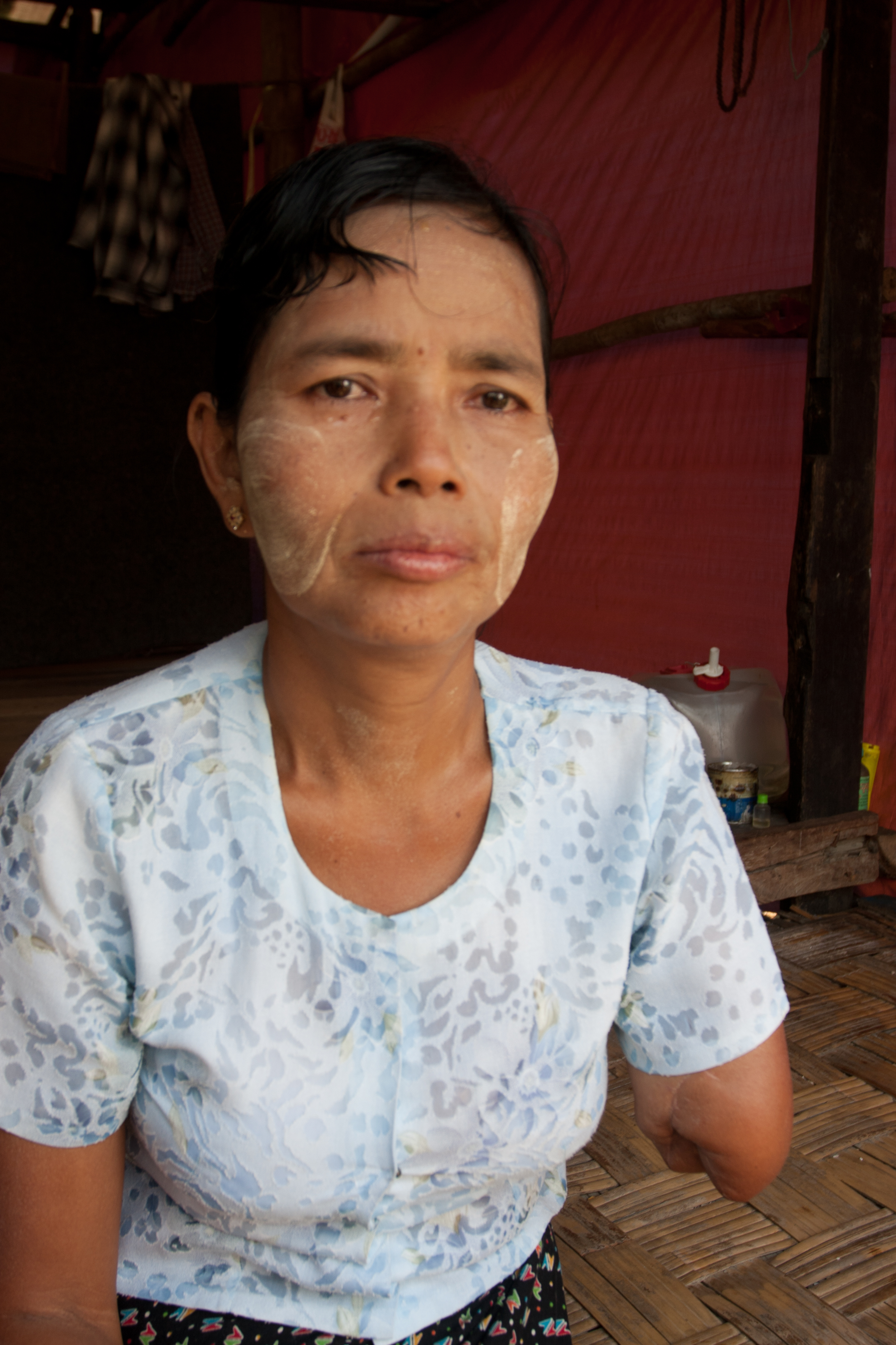 Woman with Lost Limb