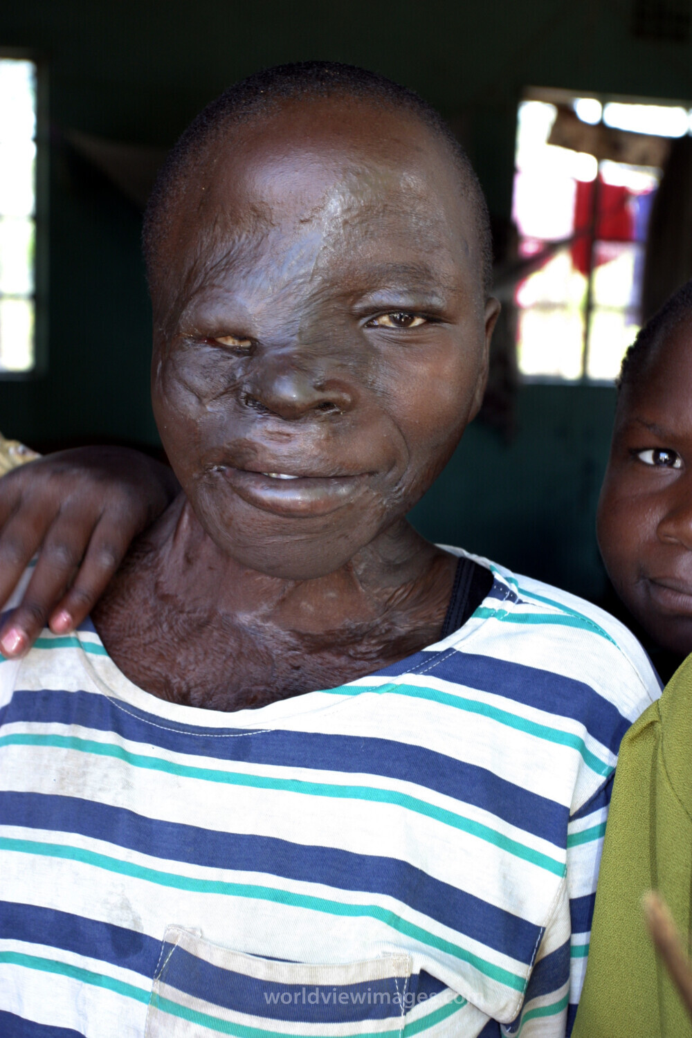 Children with Disabilities