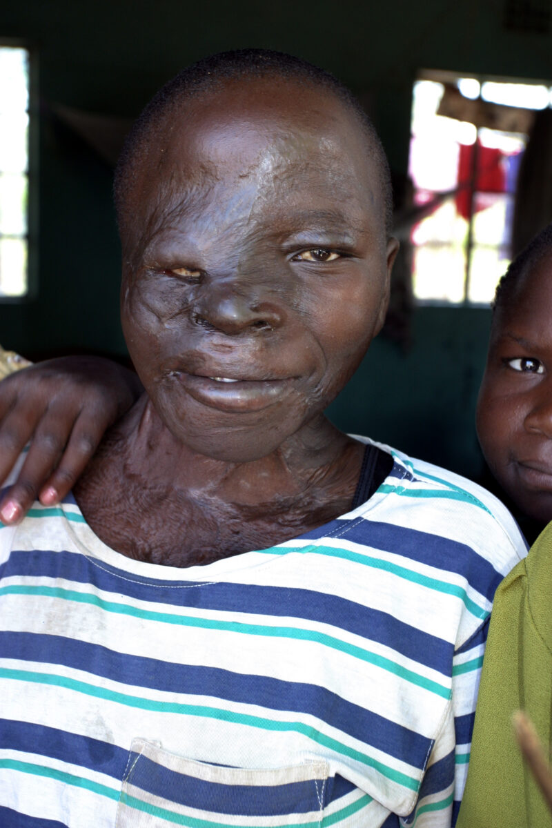 Children with Disabilities — Kenya, Africa, ADRA, Children with disabilities, Children